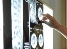 Relation entre IRM et la présence d’une lombalgie, oui ou non ?