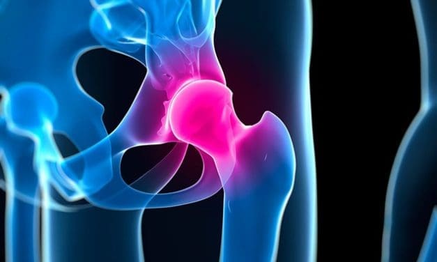 Nouvelles preuves en faveur de la Kinésithérapie pour le traitement du conflit de hanche