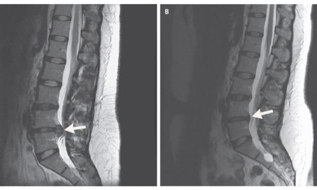 Hernie discale : pas de panique !
