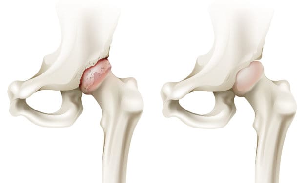 Arthrose : kinésithérapeutes et rhumatologues sont ils sur la même longueur d’onde ?