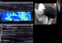 Echoscopie/Elastographie cervicale
