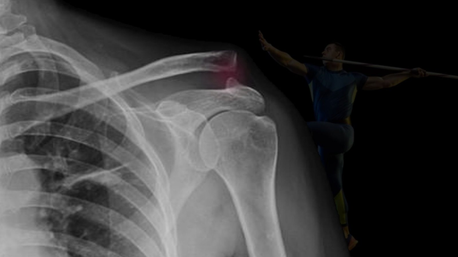 Luxation de l&rsquo;acromio-claviculaire: traitement conservateur