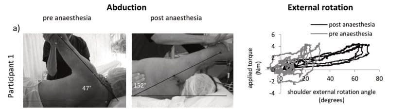 La protection musculaire joue-t-elle un rôle dans la perte de mobilité de l’épaule dans la capsulite ?