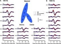 Facteur prédictif des vertiges résiduels après la récupération du vertige paroxystique paroxystique bénin (VPPB)