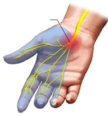 Le rapport coût-efficacité en faveur de la thérapie manuelle dans le traitement du syndrome du canal carpien