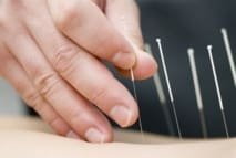Dry Needling : pas d