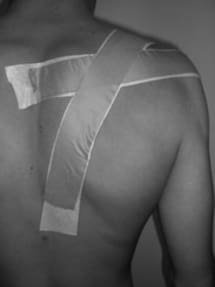 McConnell Taping et Conflit sous-acromial