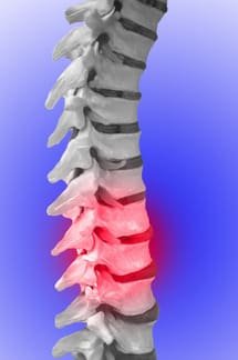 Exercices de contrôle moteur pour la lombalgie chronique: un essai contrôlé par placebo et randomisé