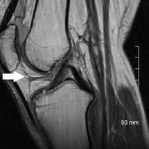 Paquet adipeux de Hoffa et gonalgie