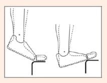 Quel programme excentrique pour une tendinopathie achilléenne corporéale ?
