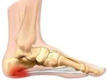 Fasciopathie plantaire : Volet 1 - Etirements ou pas ?