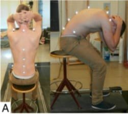 Concept Mulligan: impact de la mobilisation avec mouvement (SNAGs) sur les lombalgies non spécifiques 