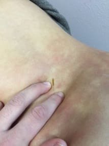 Piquer le multifide pour aider son activation ?