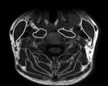 Cervicalgiques et mesure IRM de la taille des muscles cervicaux