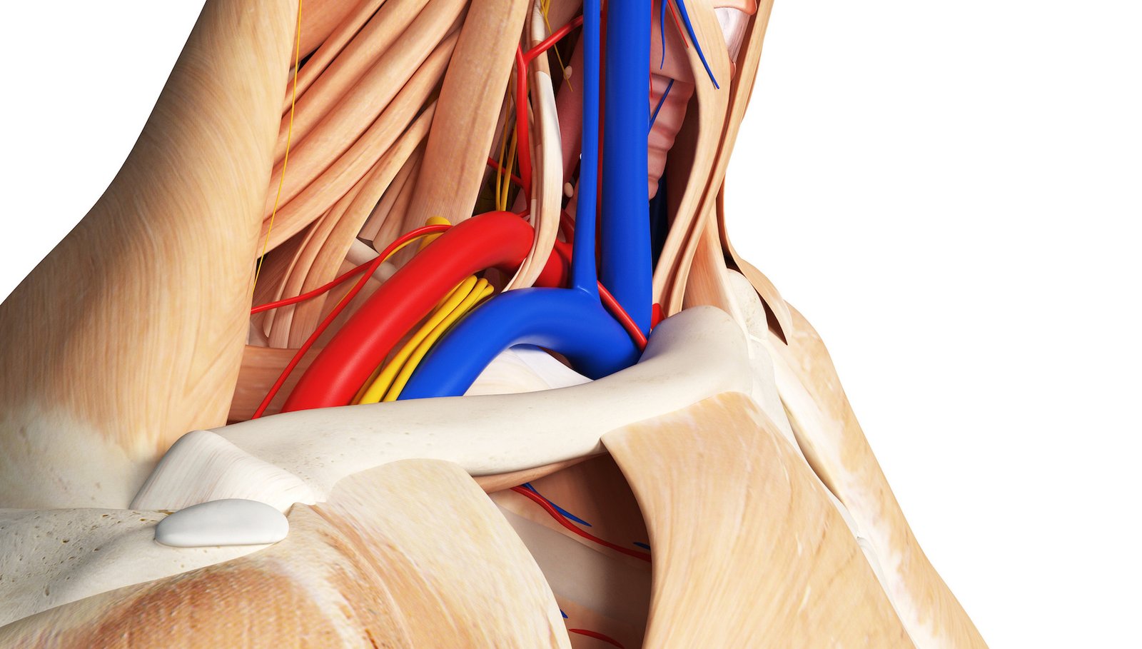Syndrome du défilé thoracobrachial