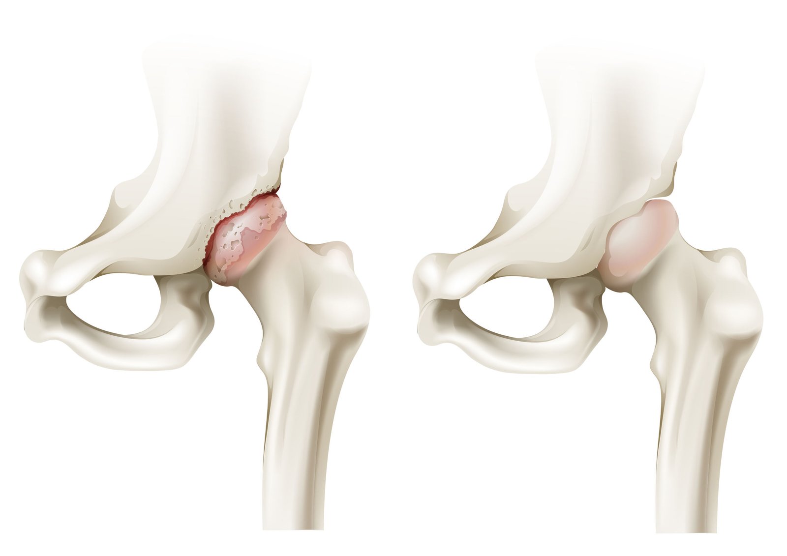 Recommandation : arthrose de genou ou de hanche
